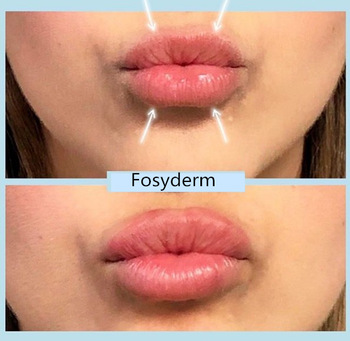 CE Certificate Hyaluronic Acid Cross Linked Dermal Filler For Fuller Lips