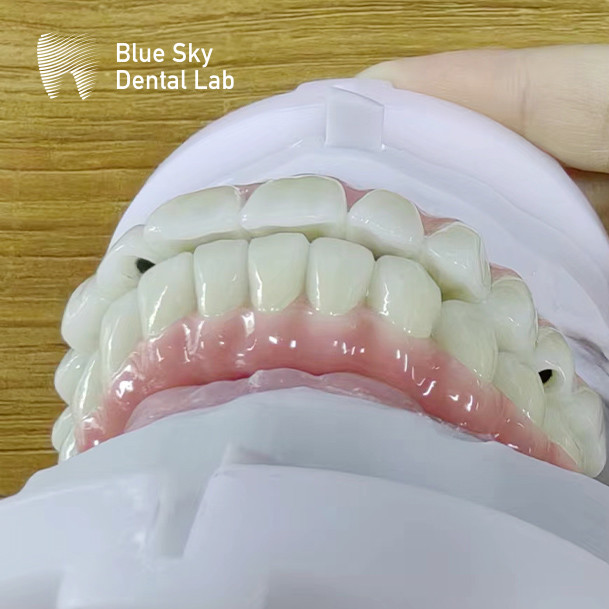 Nature Artificial Dental Implant Cases Customized Full Mouth Implant Case