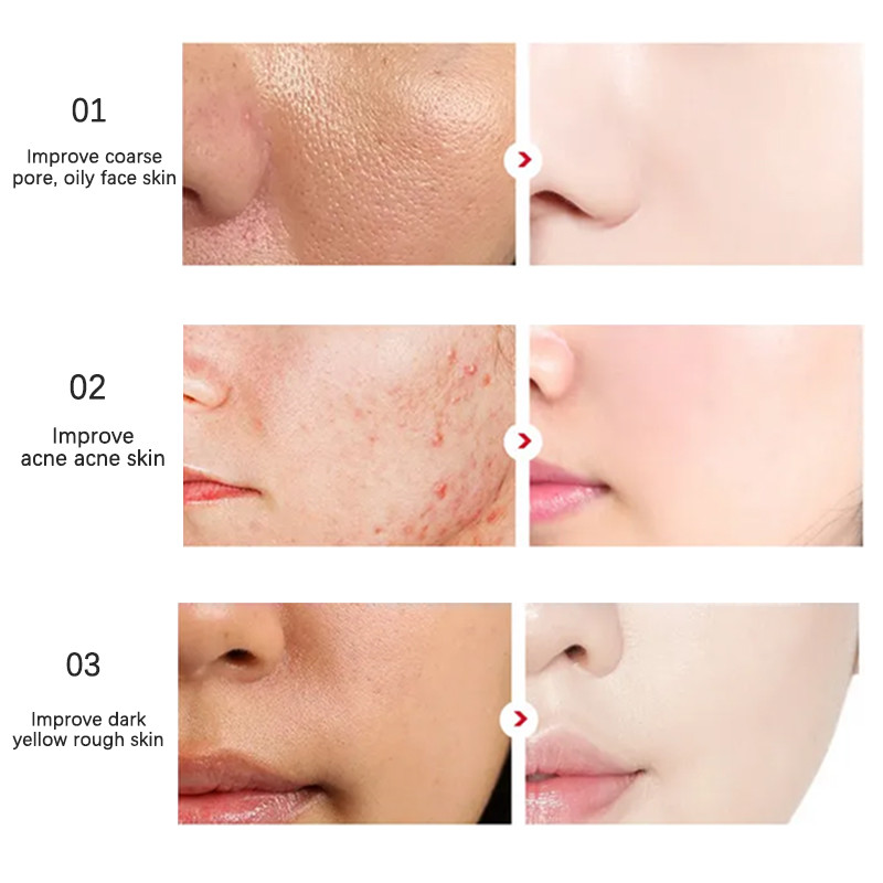 Hydrating 100ML Salicylic Acid Toner For Acne Oily Skin OEM ODM