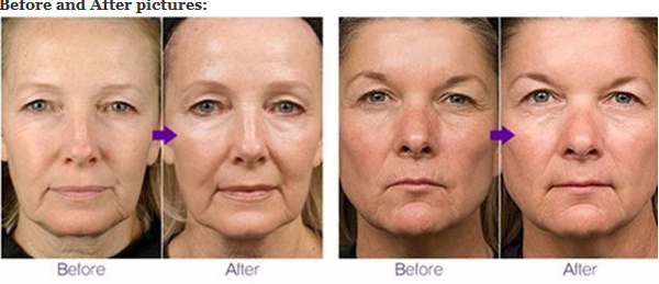Fractional RF Microneedle for beauty spa