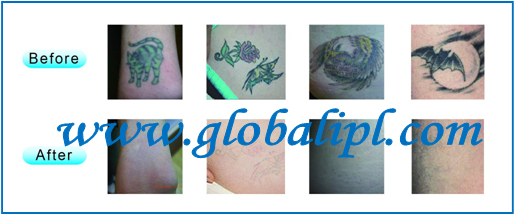 2014 hot! Desktop Tattoo Removal Laser Machine