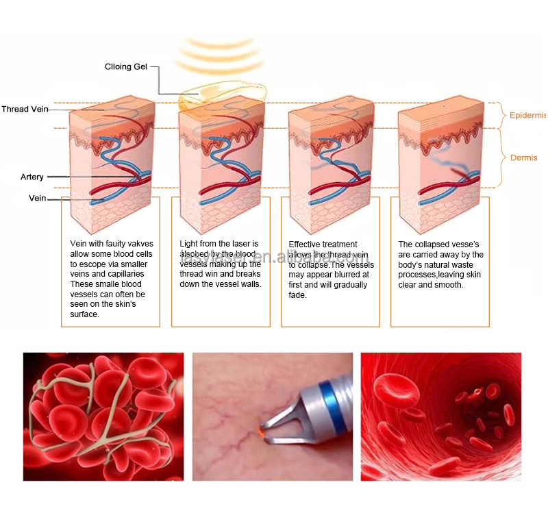 Portable 30mhz Laser Spider Vein Removal Machine , 110v 980nm Diode Laser Vascular Removal Machine