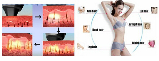 diode laser1