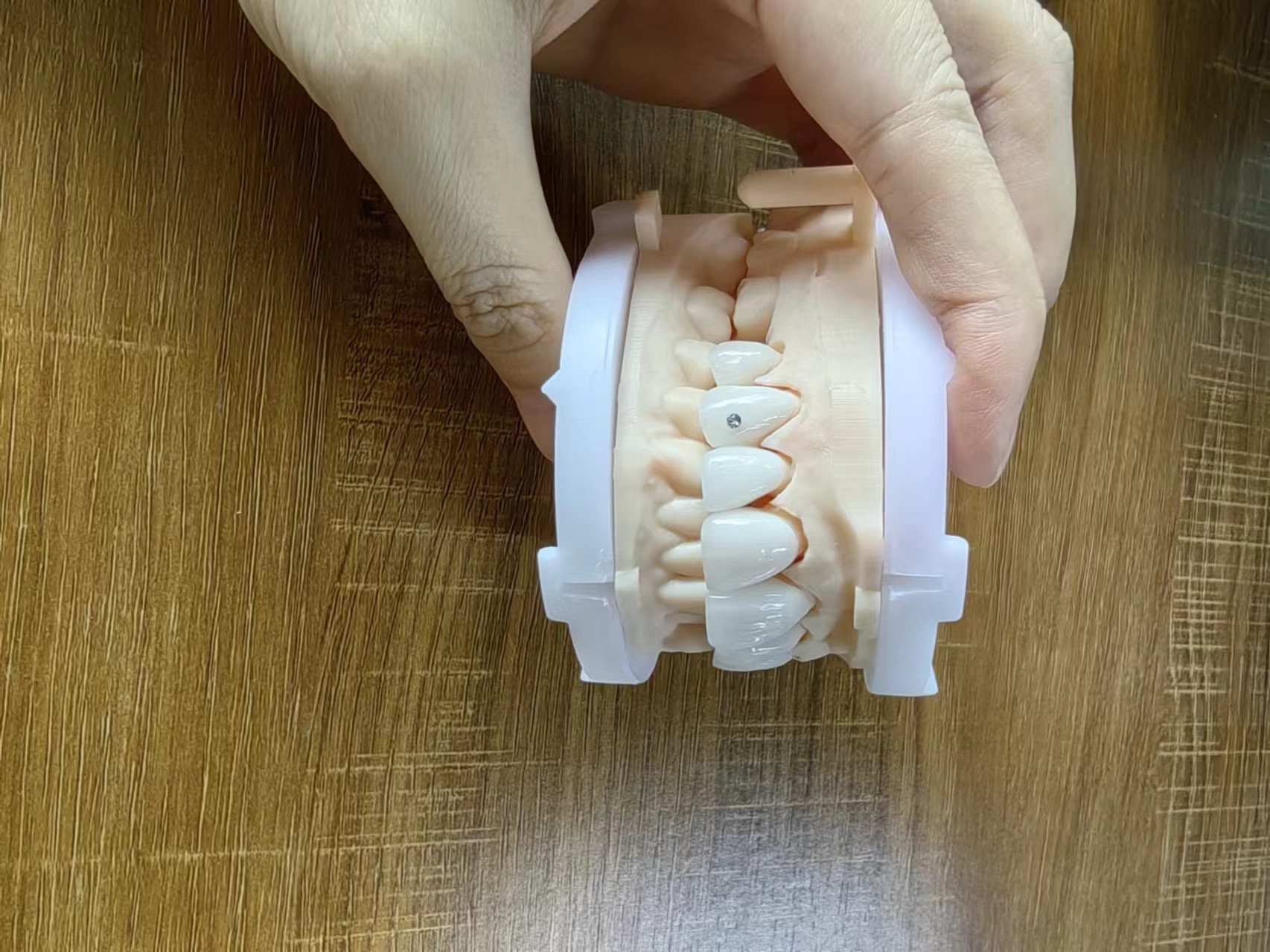 Highly Translucent Zirconia Crowns Bridge Veneers With Customized Jewelry And Gold Beautiful Dental Restoration Case