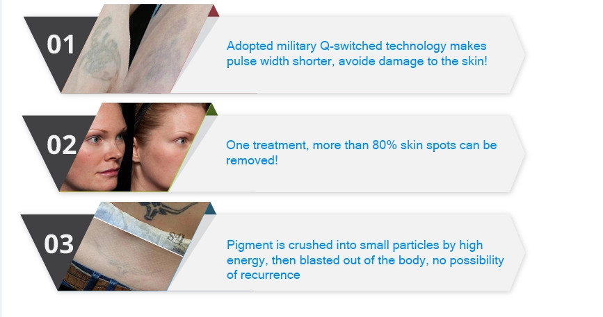 Yag laser welding machine used Professional tattoo removal machine