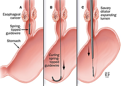 CE Marked Disposable Cardia Bougie Dilator for Esophagus