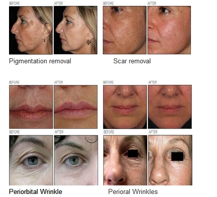 Fractional CO2 laser tube for skin resurfacing with RF pipe , glass pipe