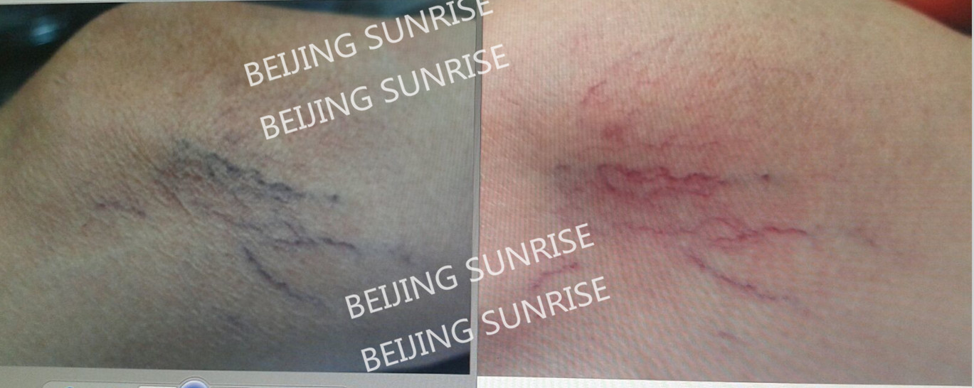 980nm beauty equipment vascular remover vascular cleaner spider veins removal
