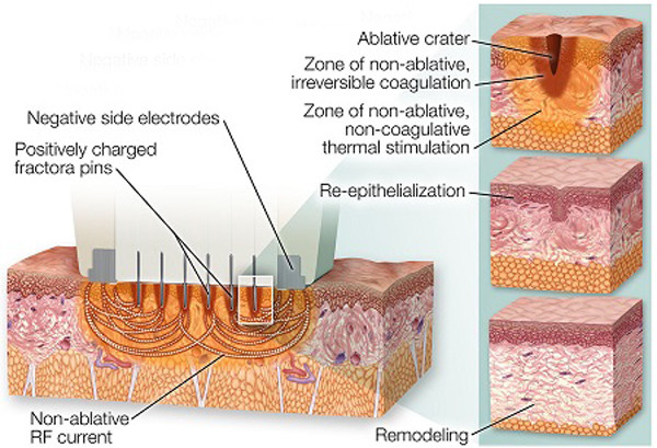 Microneedle fractional radiofrequency Secret microneedle fractional rf system