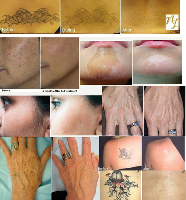 nd yag laser treatment .png