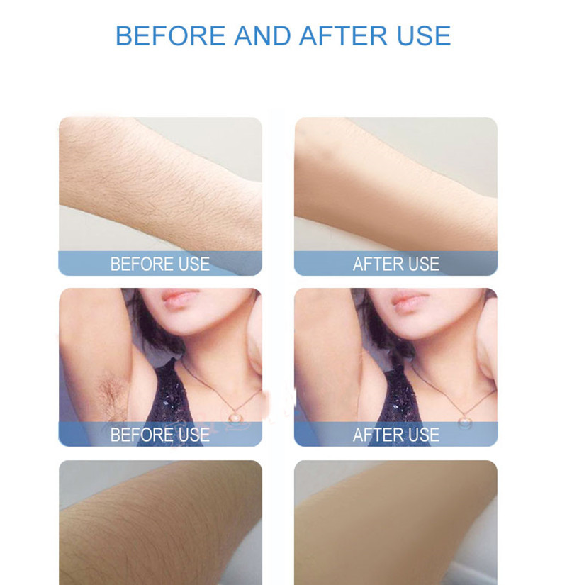Skin Rejuvenation 808nm Diode Laser Machine For Hair Removal