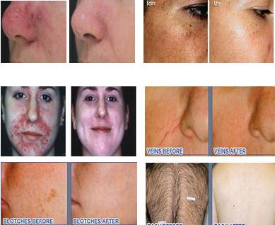 Skin clinic 1800 W IPL beauty equipment for hair removal / IPL beauty machine For permanent hair removal