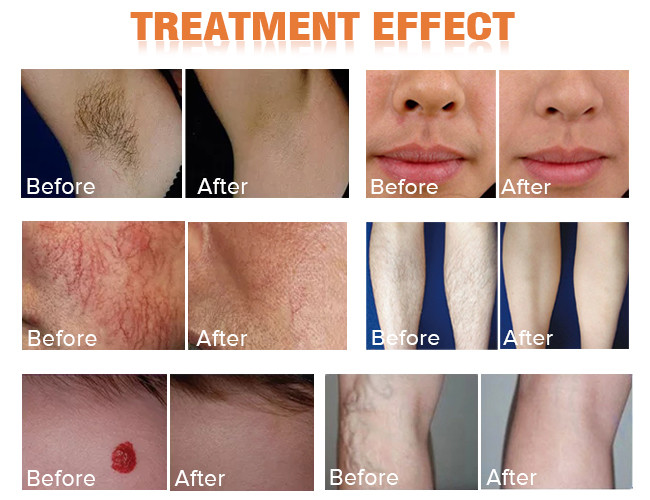 Nd YAG Alexandrite Laser Machine 1064 755 Laser Hair Removal Permanent