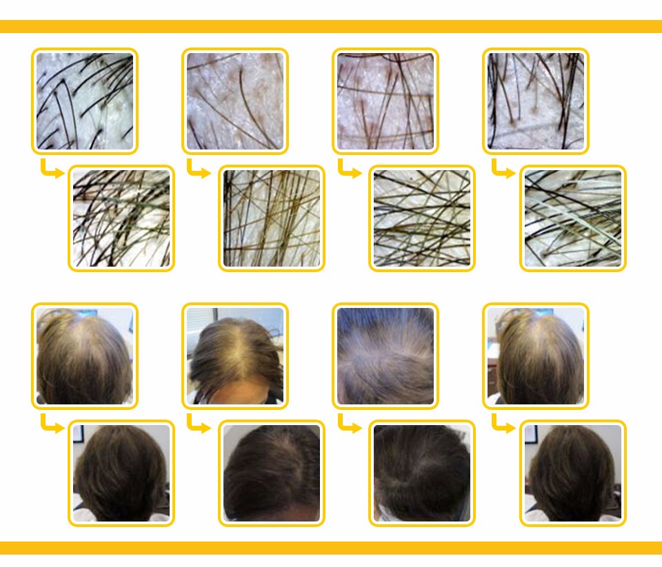 LED Laser Hair Growth Machine Vertical Photodynamic Regrowth Treatment Helmet