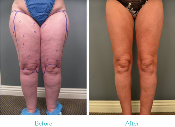 Liposuction Cavitation Slimming Machine Power Assisted