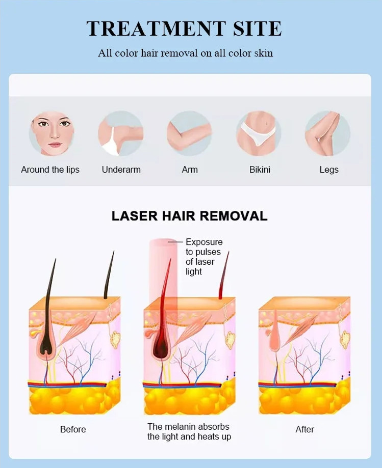 High Power Optical Filter Opt Ipl Laser Skin Rejuvenation Hair Removal Machine