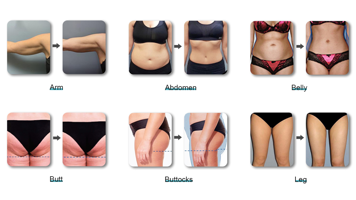 Ems Sculpting Machine 2 Handles Ems Body Sculpt Fat Removal Muscle Building EMS Shaping Slimming machine