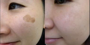 Painless Portable Q Switched Nd Yag Laser Tattoo Removal Permanent Safety Treatment