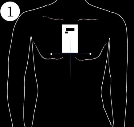 Cardiac Event Recorder Bluetooth ECG Monitor Mobile EKG Telemetry Arrhythmia/HRV Monitoring Wecardio (Alivcore Similar)
