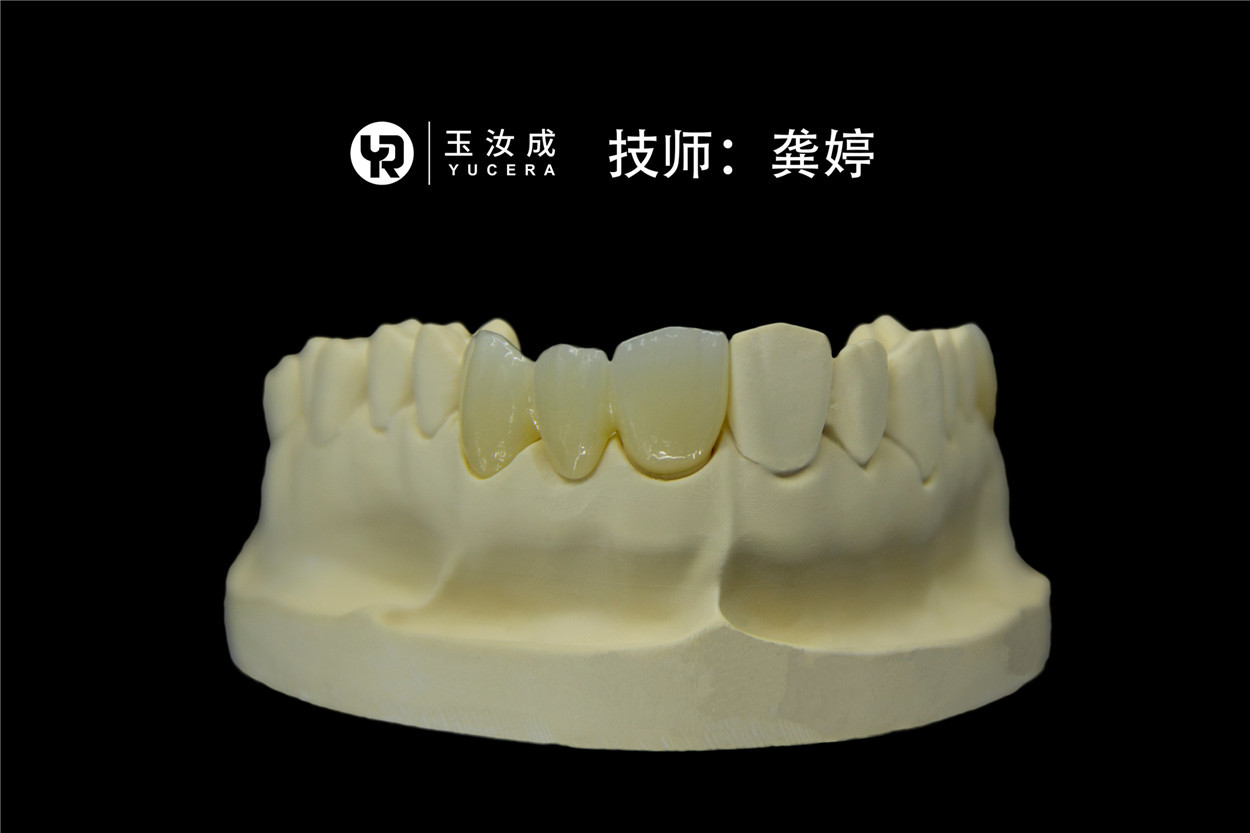 Yucera 3D Pro Multilayer Zirconia Block CAD CAM System For Anterior crown