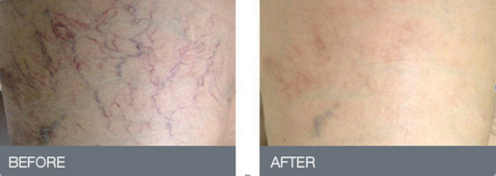 Diode 980nm Spider Vein Removal Machine FOR vascular remover
