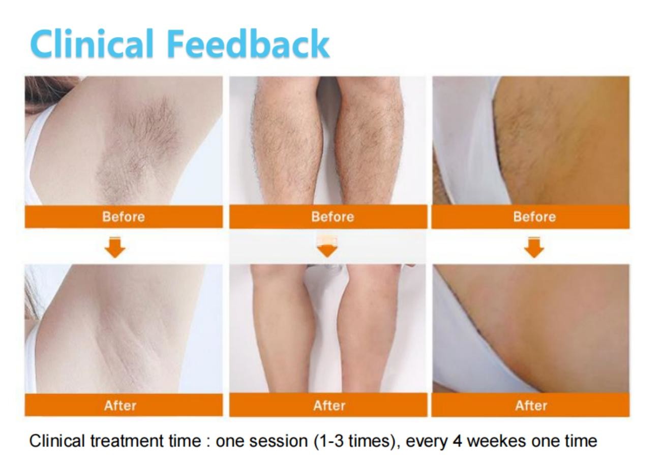 Professional-grade Diode Laser Hair Removal Machine Three Wavelength Double Handle Picosecond Laser for Tattoo Removal