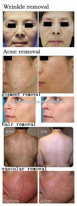 permanent hair removal portable salon use IPL SHR laser hair removal machine price