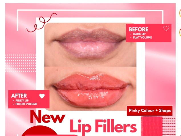 Experience Perfect Pout With HYDROIAM Kiss Lip Augmentation RED LIP Hyaluronic Acid Gel With B12