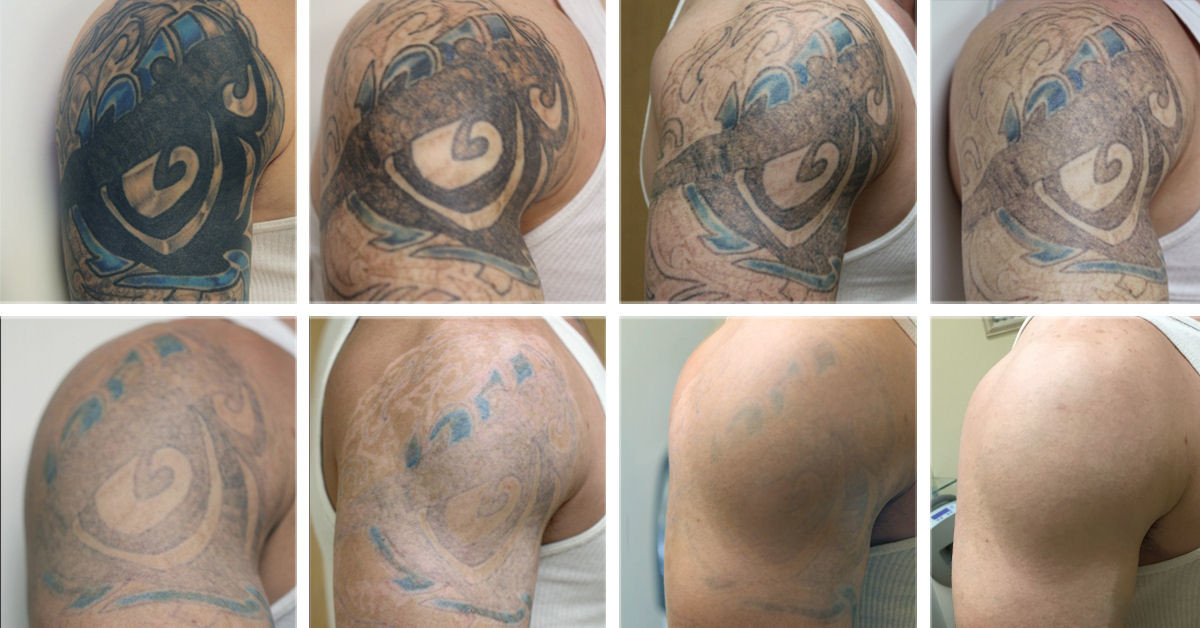 Monaliza Q Switched ND Yag Laser Tattoo Removal Machine For Shrink Pores
