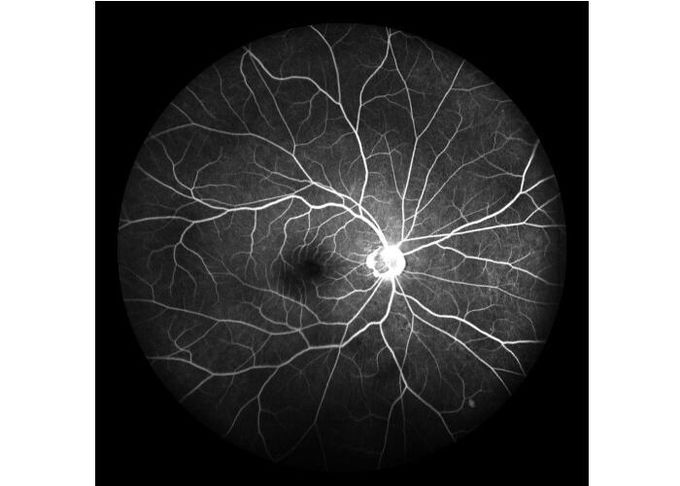 Ultra-wide Field Laser Scanning Retina Angiograph Digital Ophthalmic Equipment With Optical Zoom 100°/60°/30°