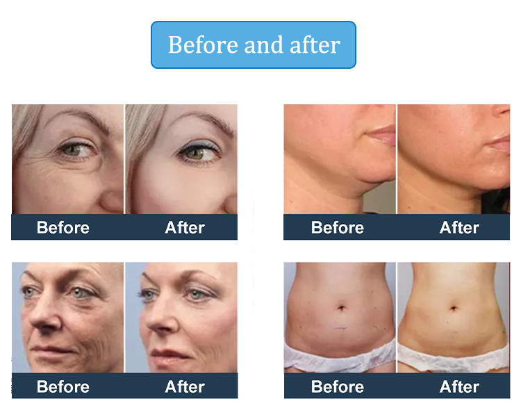 5 In 1 Smas Face And Neck Lift HIFU High Intensity Focused Ultrasound Machine