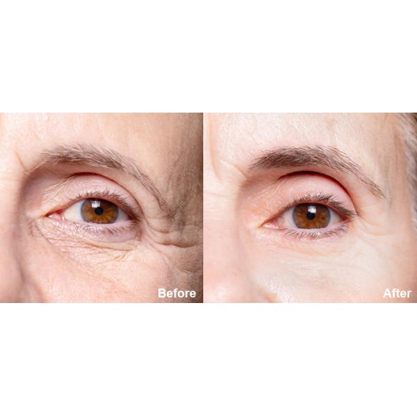 Professional 40.68Mhz Rf Face Lifting Machine Wrinkle Remove 40.68Mhz