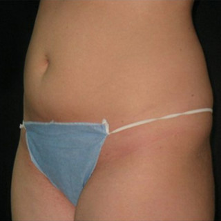 UltraShape-before-1549481-2138404.jpg
