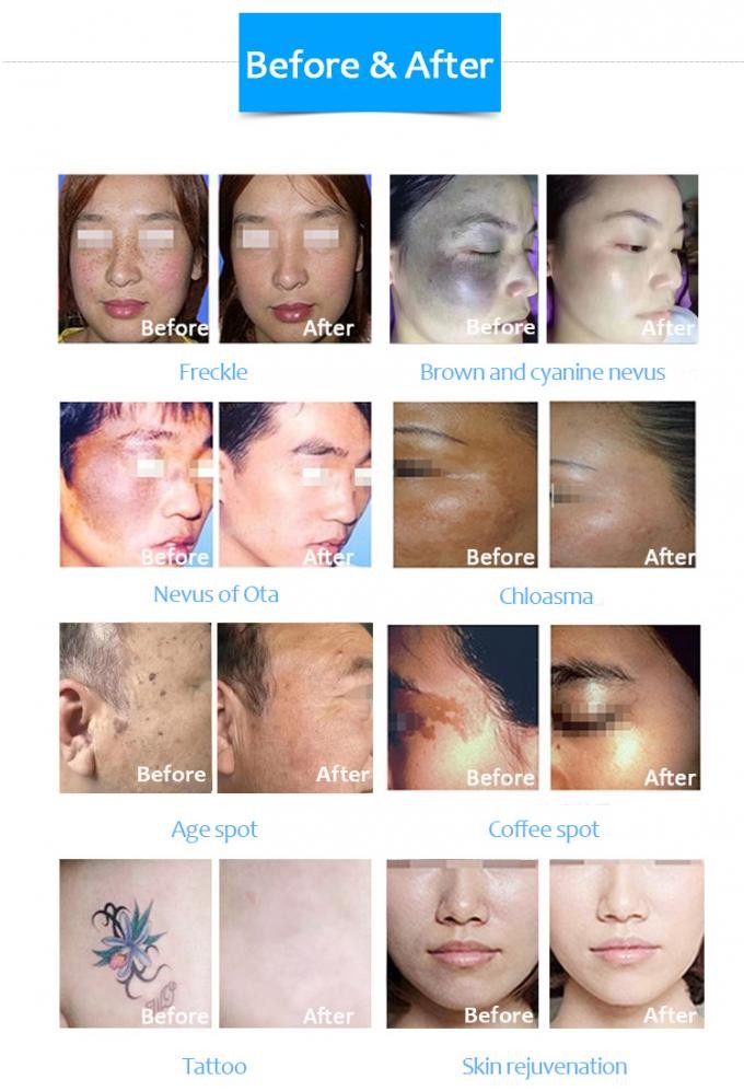 Pigment Removal CO2 Fractional Laser Machine 10600nm Skin Rejuvenation