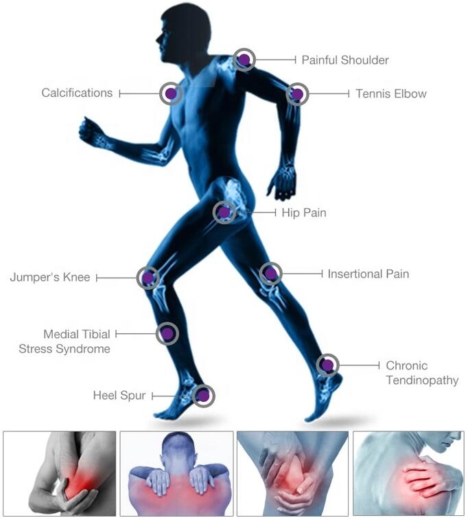 3D Acoustic shockwave therapy equipment / acoustic wave therapy shockwave /ultrasonic fat loss equipment shockwave