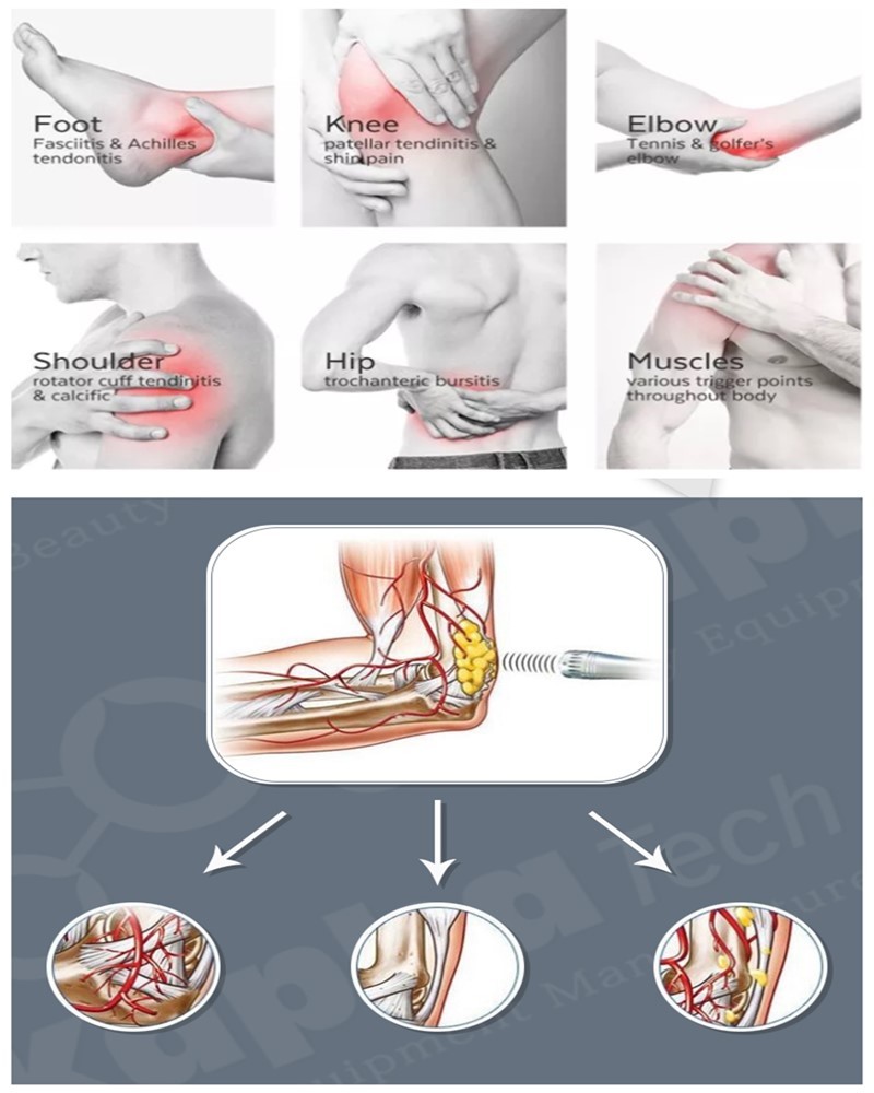 Extracorporeal Air Pressure Therapy Machine Acoustic Wave Type For Sports Injury Recovery
