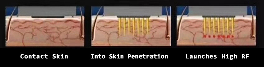 Skin Rejuvenation 100V To 240V Microneedle RF Machine