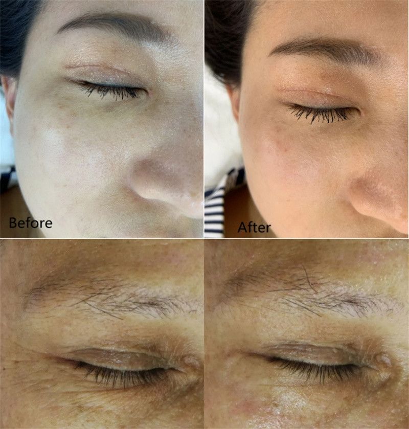 Rf Ems Vibrating Massager Eyes Care Anti Aging Wrinkle Removal Eye Device