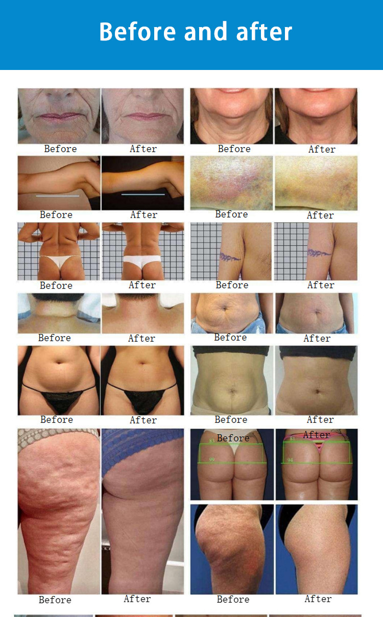 40K Vacuum Cavitation Machine RF Therapy Skin Tightening 360 Rotation