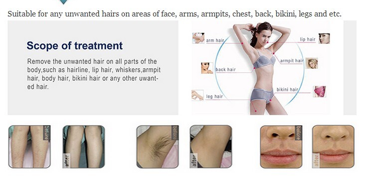 600w Diode Laser Hair Removal Machine with High Power Germany Bars