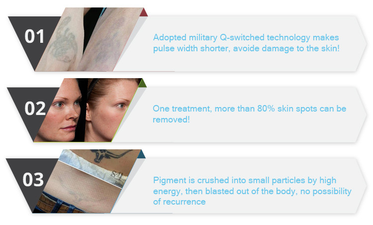 q-switch laser tattoo removal machine cheap laser tattoo removal machines