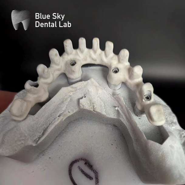 Titanium Frame Malo Bridge Dental Custom Malo Implant Bridge