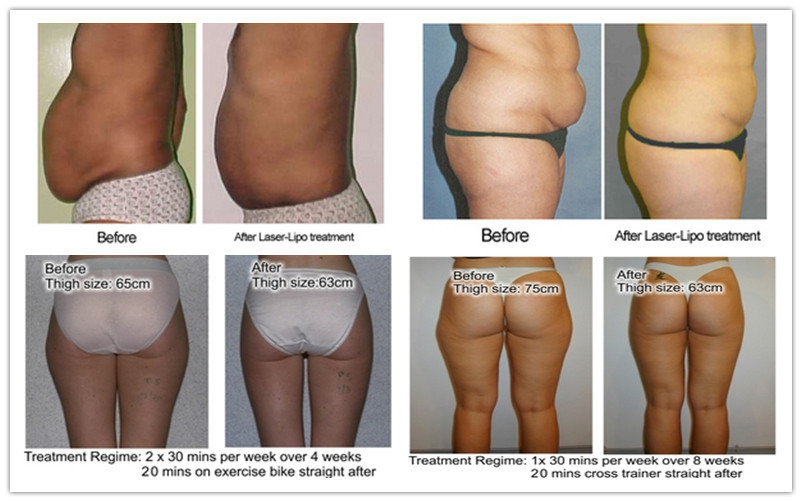 super diode laser slimming machine before after picture.jpg
