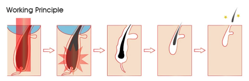 Body Hair Removal Medical Beauty Machine with 1064nm Wavelength and ABS Case Material