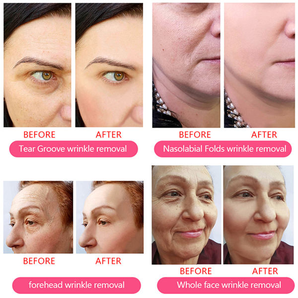 Crosslinked 1ml Hyaluronic Acid Dermal Filler Sodium Injection