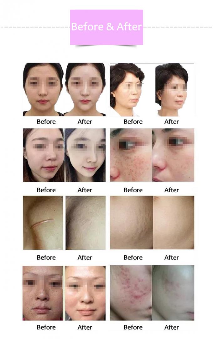 RF Beauty Salon Equipment Gold RF Micro Needle For Wrinkle Removal Skin Tightening 2