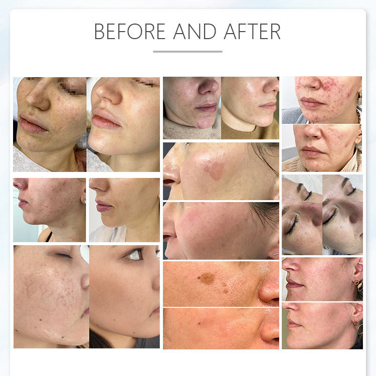 480nm Portable Diode Laser Hair Removal Machine For Facial Lifting Skin