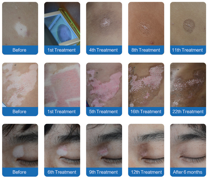 XECL-308D Homeuse 308nm Vitiligo Excimer Laser Targeted Treatment Excimer Light
