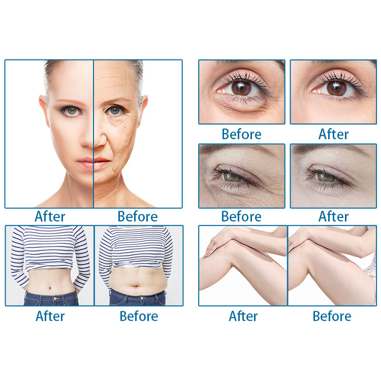 Beauty HIFU Slimming Machine 5 In 1 Multifunction 5D Wrinkle Removal Device