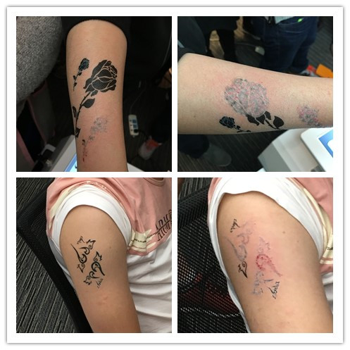 Factory direct sale!!!q-switch nd yag laser tattoo removal machine for sale